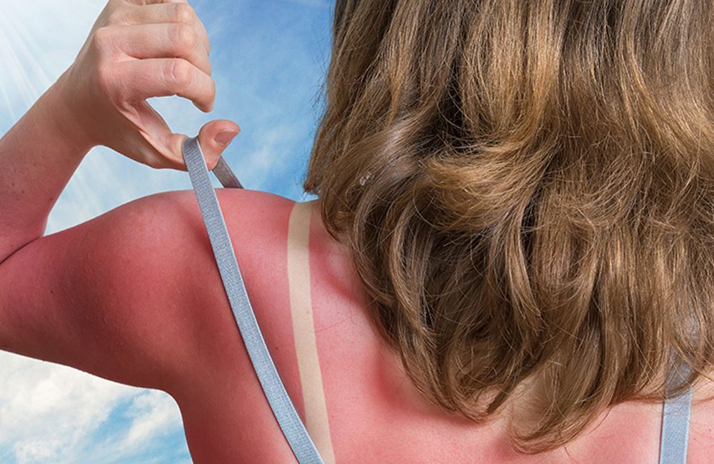 Eritema Solare? Scopriamo come affrontarlo